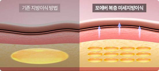 기존 지방이식 vs 복층 미세지방이식